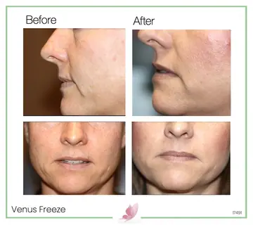Before and after: Venus Freeze