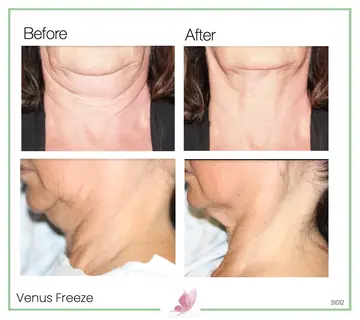 Before and after: Venus Freeze