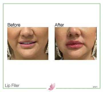 Before and after: Lip Fillers