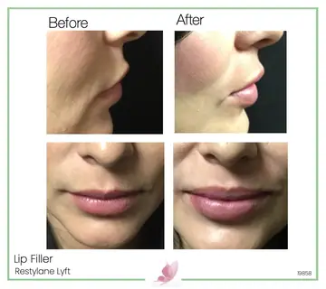 Before and after: Lip Fillers