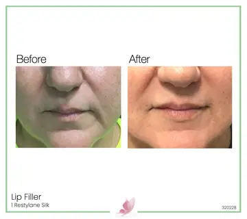 Before and after: Lip Fillers