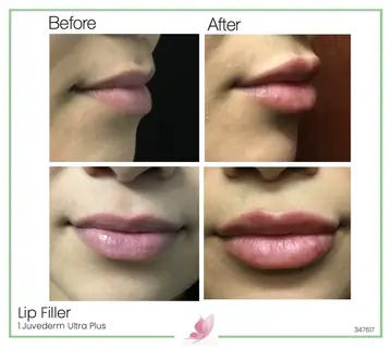 Before and after: Lip Fillers