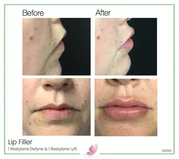 Before and after: Lip Fillers