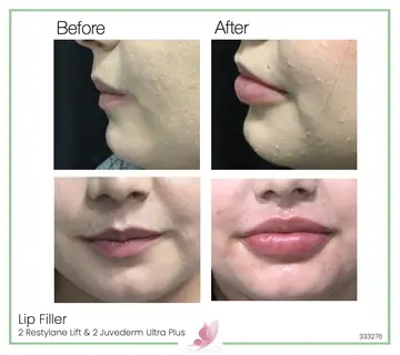 Before and after: Lip Fillers