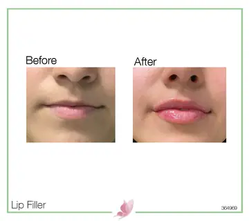 Before and after: Lip Fillers