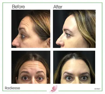 Before and after: Radiesse