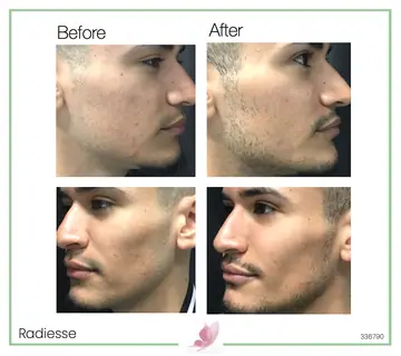Before and after: Botox & Fillers for Men