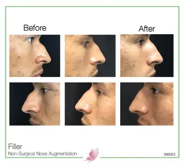 Before and after: Botox & Fillers for Men
