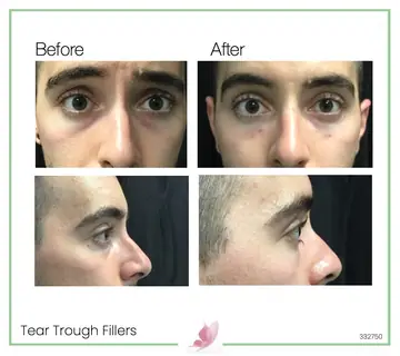Before and after: Botox & Fillers for Men