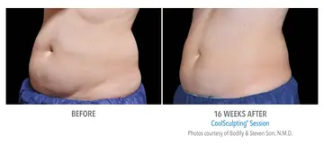 Before and after: Cool Sculpting