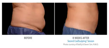 Before and after: Cool Sculpting