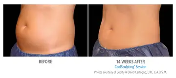 Before and after: Cool Sculpting