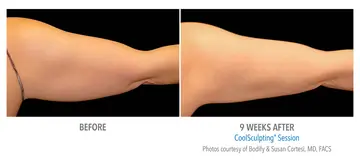 Before and after: Cool Sculpting