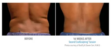 Before and after: Cool Sculpting