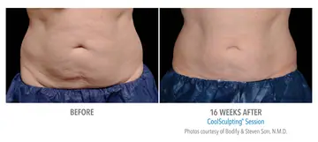 Before and after: Cool Sculpting