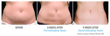 Before and after: Cool Sculpting