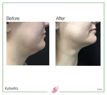 Before and after: Kybella
