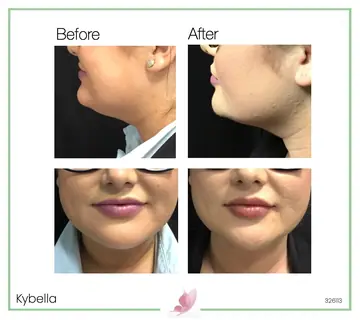 Before and after: Kybella