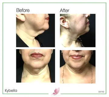 Before and after: Kybella