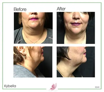 Before and after: Kybella