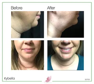 Before and after: Kybella