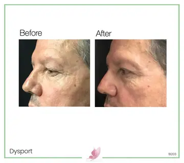 Before and after: Botox & Fillers for Men