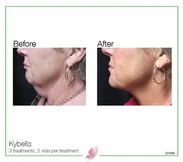 Before and after: Kybella