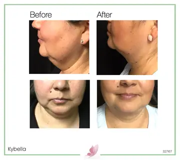Before and after: Kybella