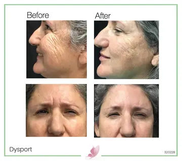 Before and after: Dysport