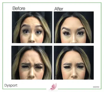 Before and after: Dysport