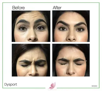 Before and after: Dysport