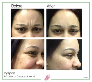 Before and after: Dysport