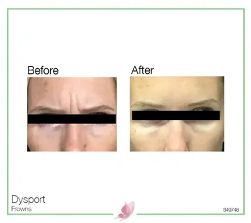 Before and after: Dysport