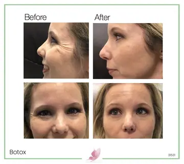 Before and after: Botox