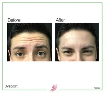 Before and after: Botox & Fillers for Men