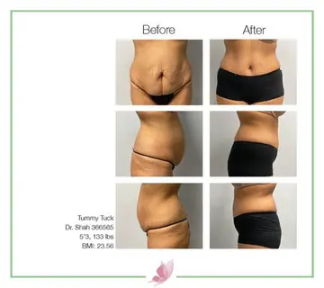 Before and after: Tummy Tuck, Dr. Darshan R. Shah