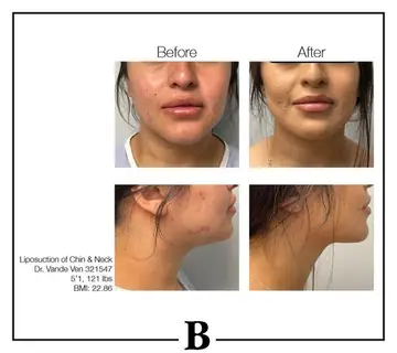 Before and after: Liposuction, Dr. Heather Vande Ven