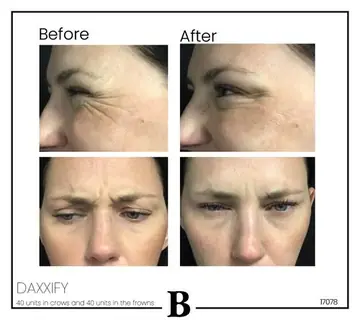 Before and after: DAXXIFY