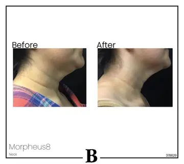 Before and after: Morpheus8