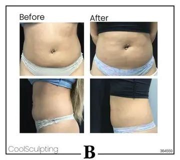 Before and after: Cool Sculpting
