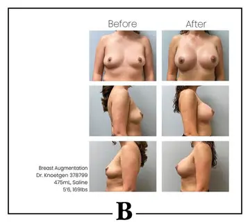 Before and after: Breast Augmentation, Dr. James Knoetgen