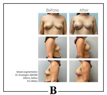 Before and after: Breast Augmentation, Dr. James Knoetgen