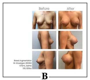 Before and after: Breast Augmentation, Dr. James Knoetgen