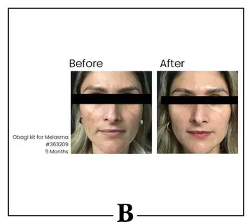 Before and after: Obagi