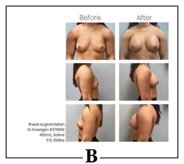 Before and after: Breast Augmentation, Dr. James Knoetgen