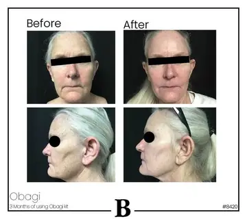 Before and after: Obagi