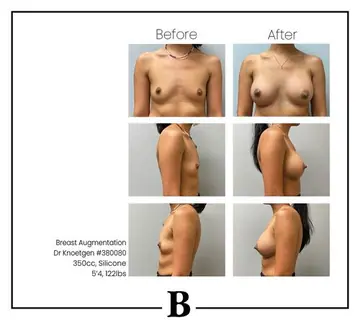 Before and after: Breast Augmentation, Dr. James Knoetgen