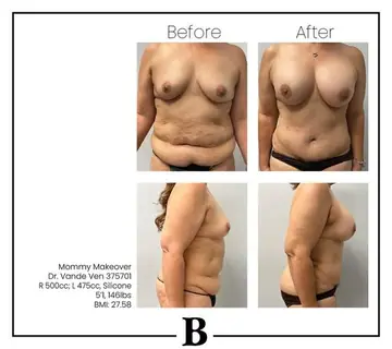 Before and after: Mommy Makeover, Dr. Heather Vande Ven