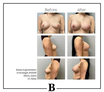 Before and after: Breast Augmentation, Dr. James Knoetgen