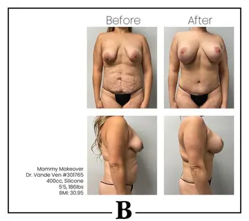Before and after: Mommy Makeover, Dr. Heather Vande Ven